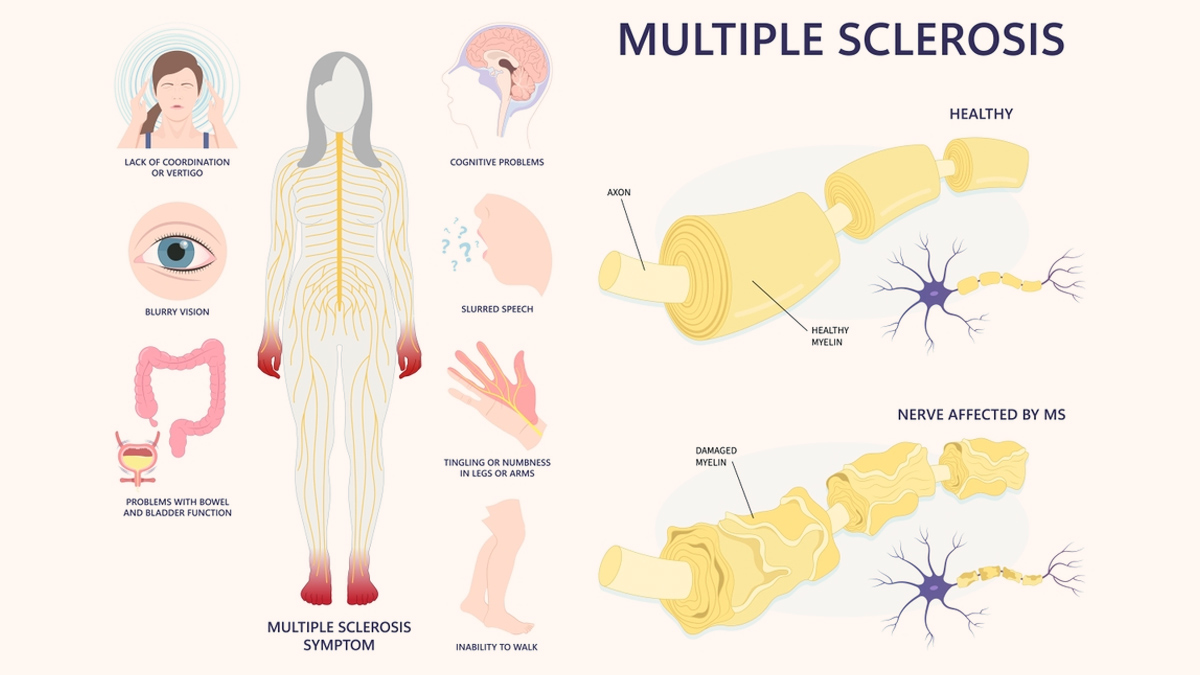 World Multiple Sclerosis Day 2024 Theme, History And Its Significance